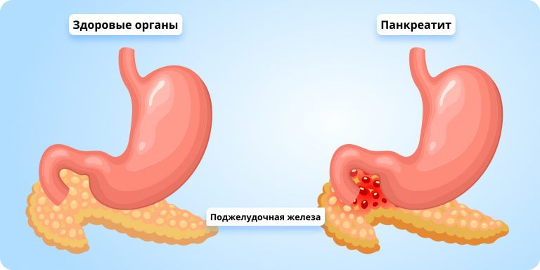 Поджелудочную реально вылечить за 3 недели без медикаментов