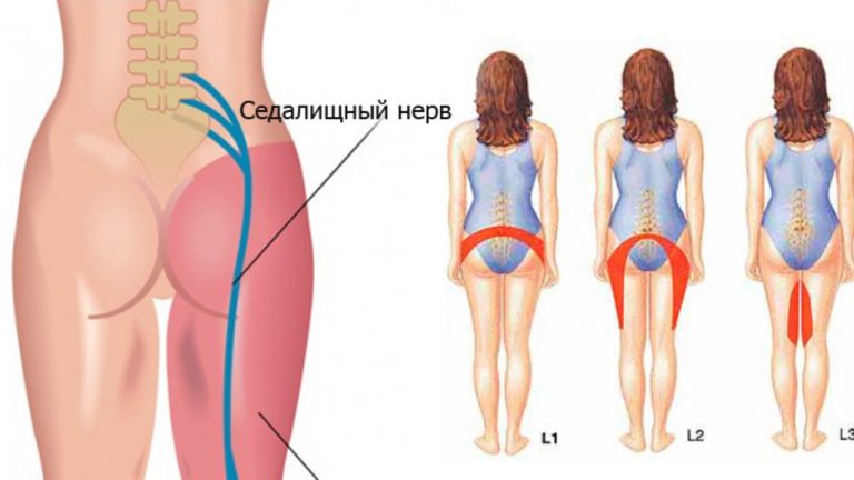 2 простых способа разблокировать седалищный нерв и унять боль