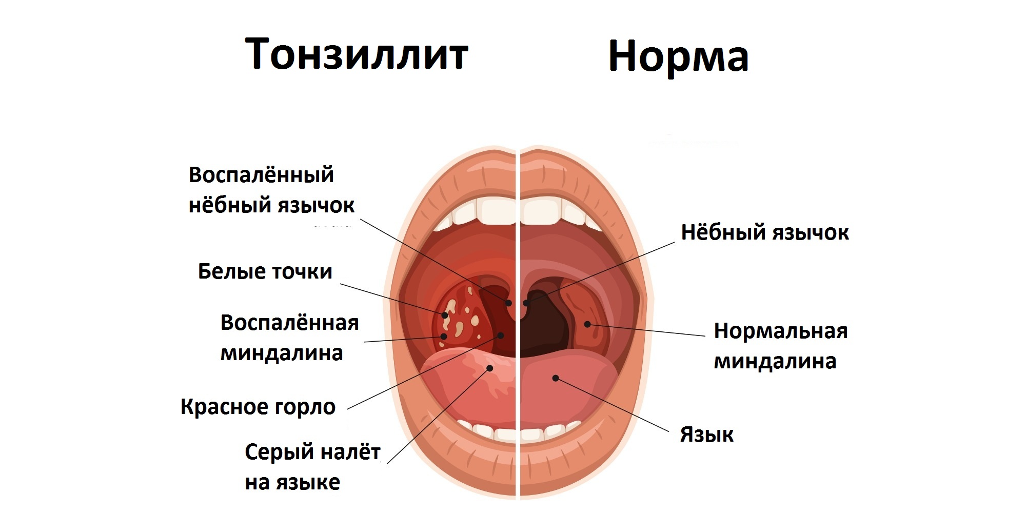 ангина как выглядит горло
