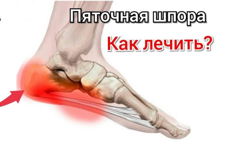 БЫСТРО ВЫЛЕЧИЛА ШПОРУ ЗА 3 ДНЯ
