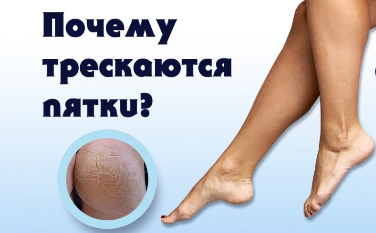 Что делать, если трескаются пятки