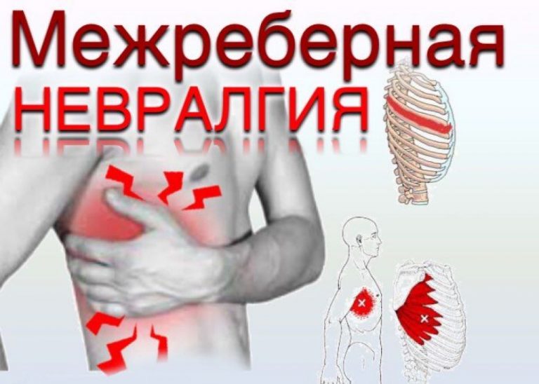 ЛЕЧИМ МЕЖРЕБЕРНУЮ НЕВРАЛГИЮ