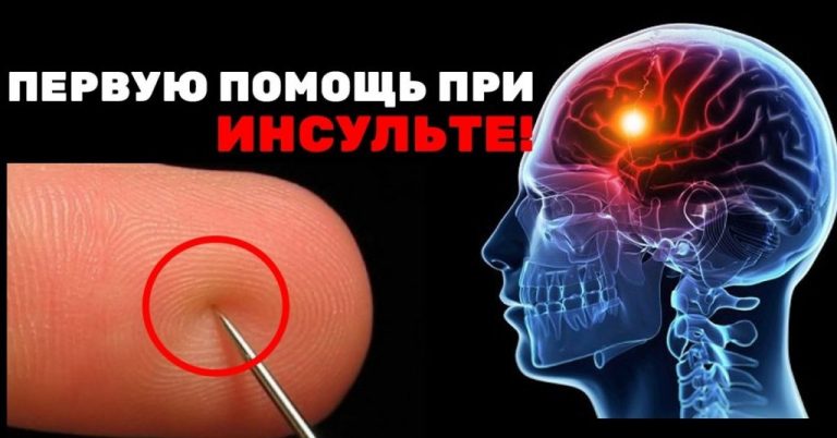 Первая помощь при инсульте: Вашу жизнь спасет всего лишь одна игла