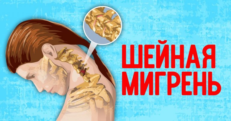 ШЕЙНАЯ МИГРЕНЬ: не старайтесь побороть таблетками