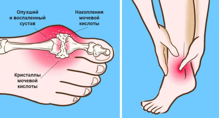 Удали мочевую кислоту и предотврати подагру и боли в суставах
