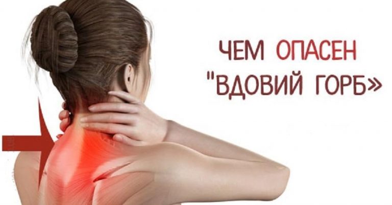 Вдовий горб: почему нужно лечить отложение солей на шее