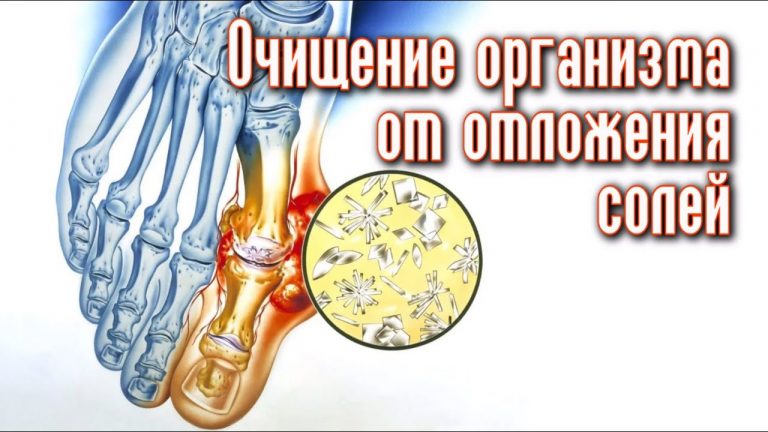 Выводим отложения солей из суставов навсегда