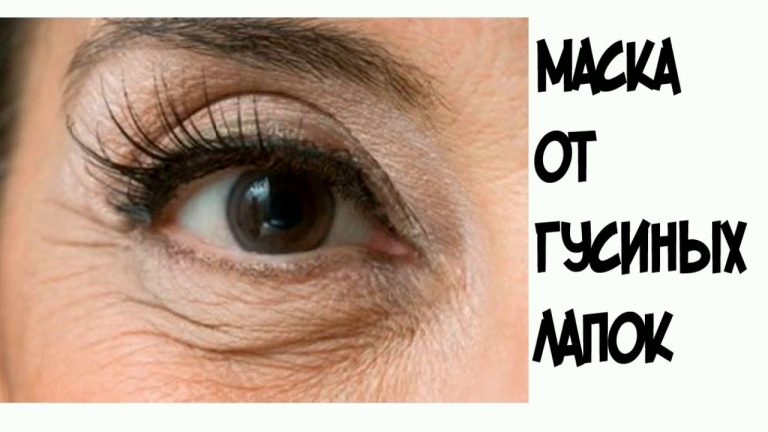 Я избавилась от «гусиных лапок». Делюсь простым и эффективным рецептом с Вами