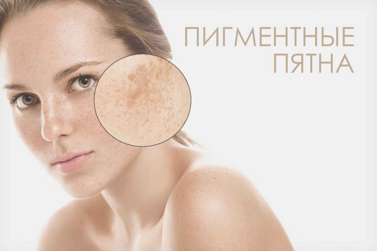 Я врач — дерматолог. И я знаю только 1 способ избавиться от коричневых пятен на коже