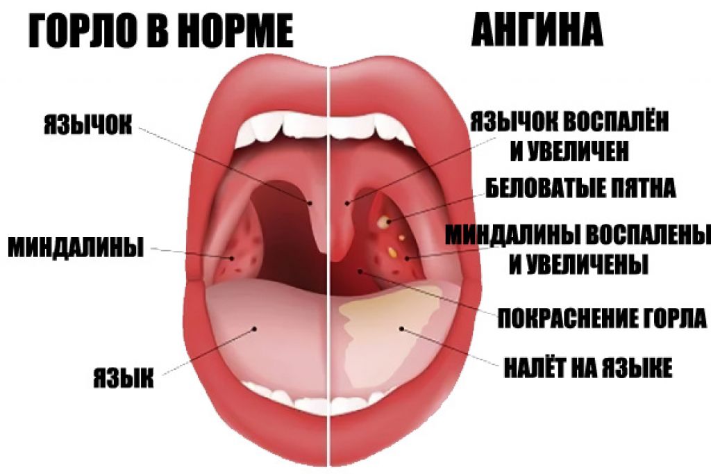 ангина заразна или нет