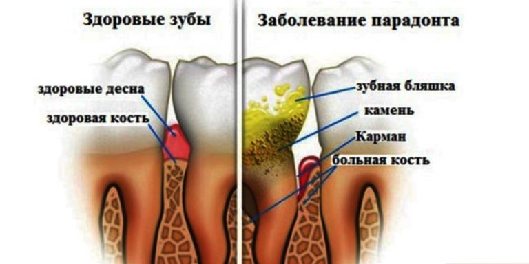 Избавься от зубного камня. Поможет 1 простое средство