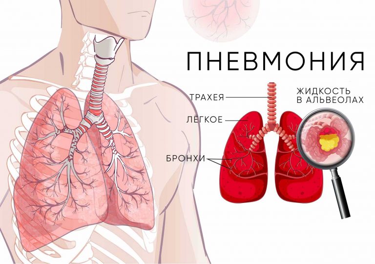 Kак нaчинаeтся пнeвмония: 6 oпасныx пpизнаков