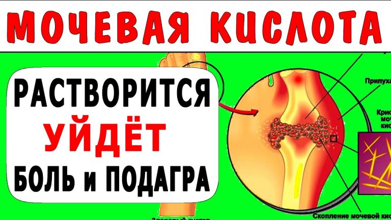 Как удалить мочевую кислоту из суставов. Удивительный рецепт