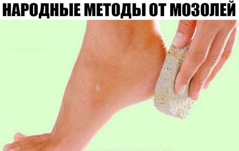 НАРОДНЫЕ МЕТОДЫ ОТ МОЗОЛЕЙ