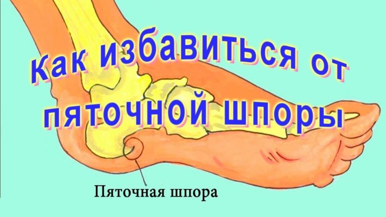Проверенный рецепт. Избавляемся от пяточной шпоры