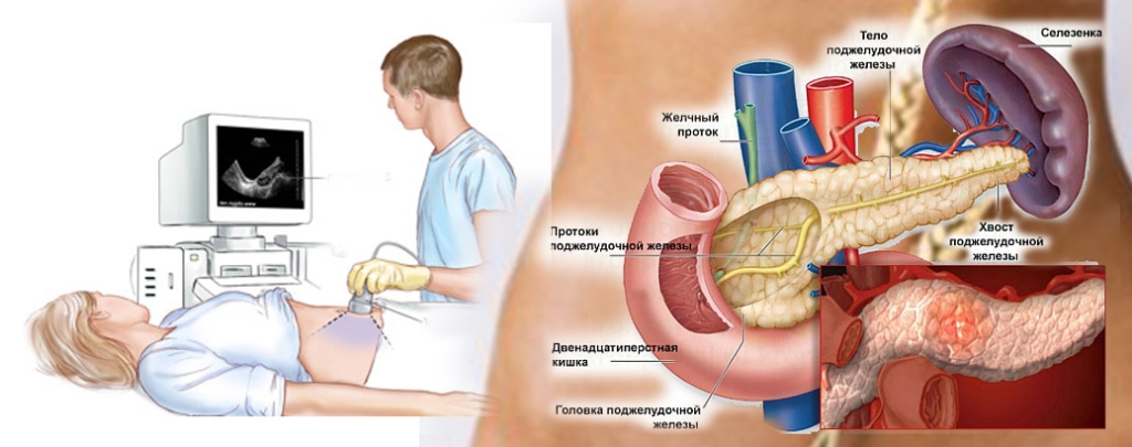 панκреатит+0603