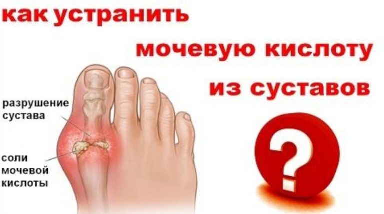 Как снизить уровень мочевой кислоты в организме