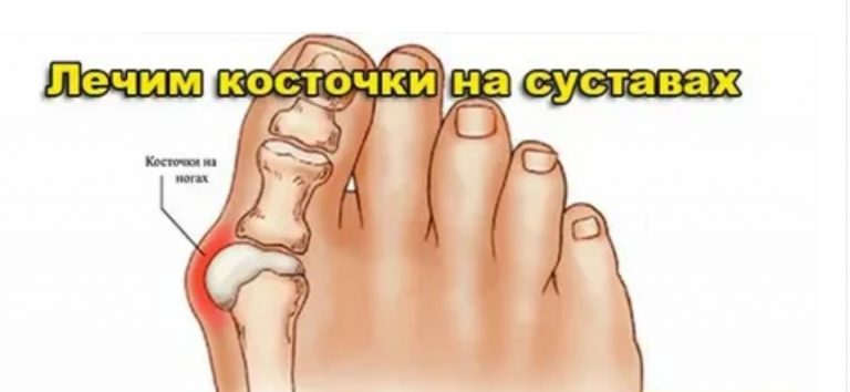 ЛЕЧИМ КОСТОЧКИ НА СУСТАВАХ