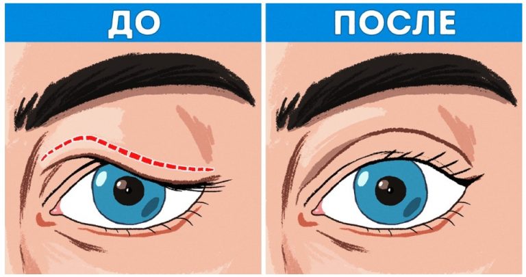 Подтягиваем нависшие веки без пластики. Всего 1 компонент