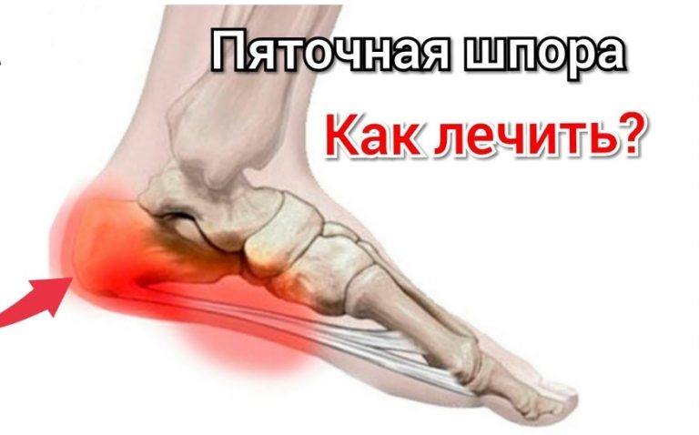 Пяточная шпора. Народные методы лечения пяточной шпоры
