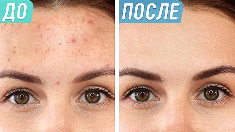 Вы не поверите, насколько легко избавиться от угревой сыпи