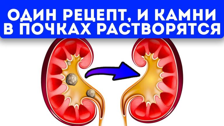 Попрощайтесь с камнями в почках за неделю — Удивительный рецепт