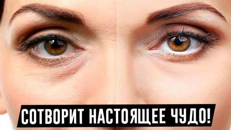 Солкосерил — одно из лучших средств от морщин вокруг глаз