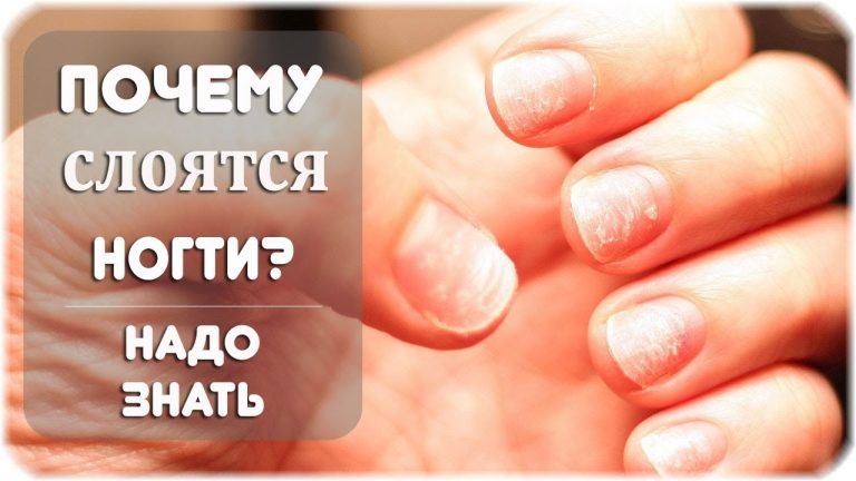 Ваши ногти слоятся и ломаются. Вот то, что Ваш организм пытается сказать Вам