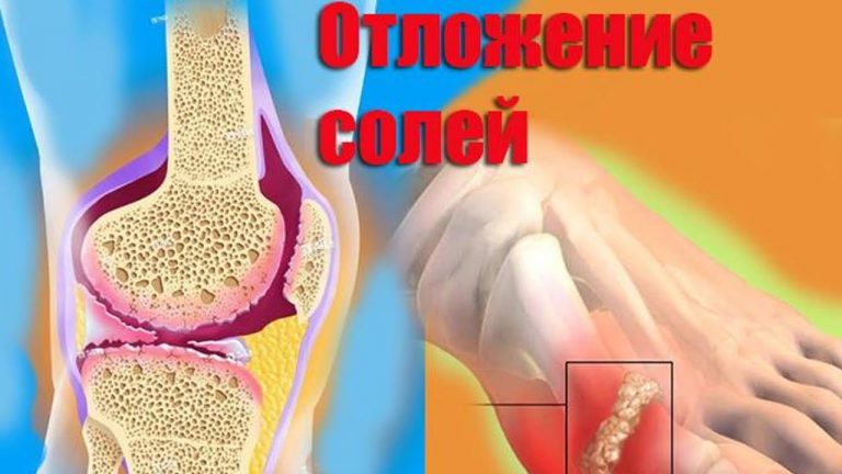 Выводим отложения солей из суставов навсегда