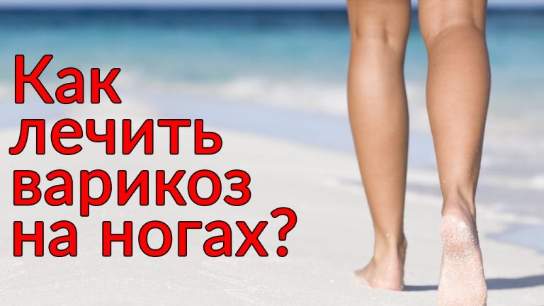 11 домашних средств против варикоза