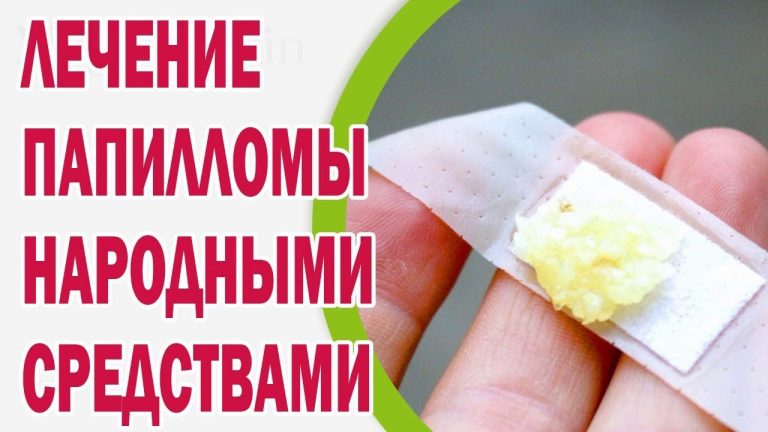 Избавься от папиллом и бородавок навсегда. Это средство есть у каждого дома