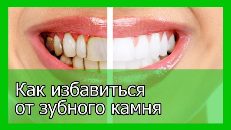 Как избавиться от зубного камня и осветлить пожелтевшую эмаль