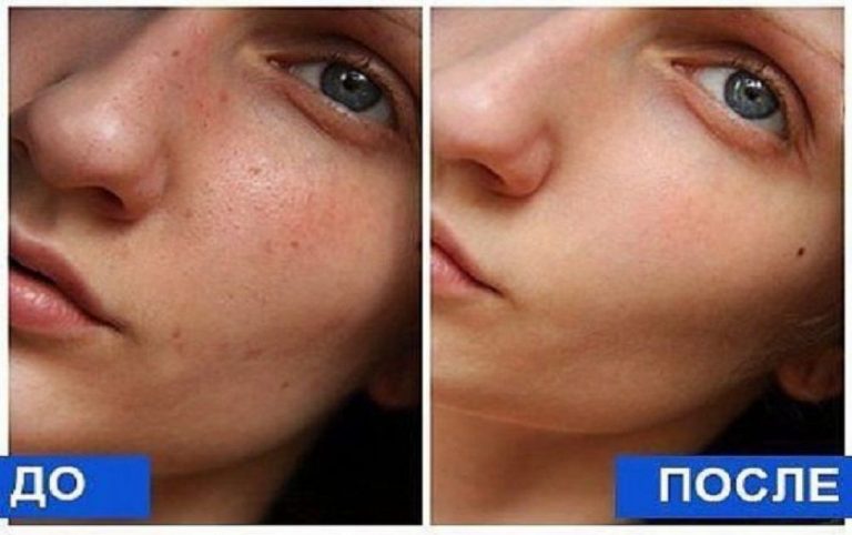 Как за одну процедуру сделать глубокую чистку лица — это рекомендуют даже косметологи