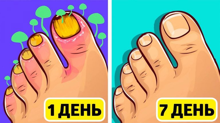 Навсегда удалить грибок с ногтей рук и ног помогут эти 2 натуральных средства