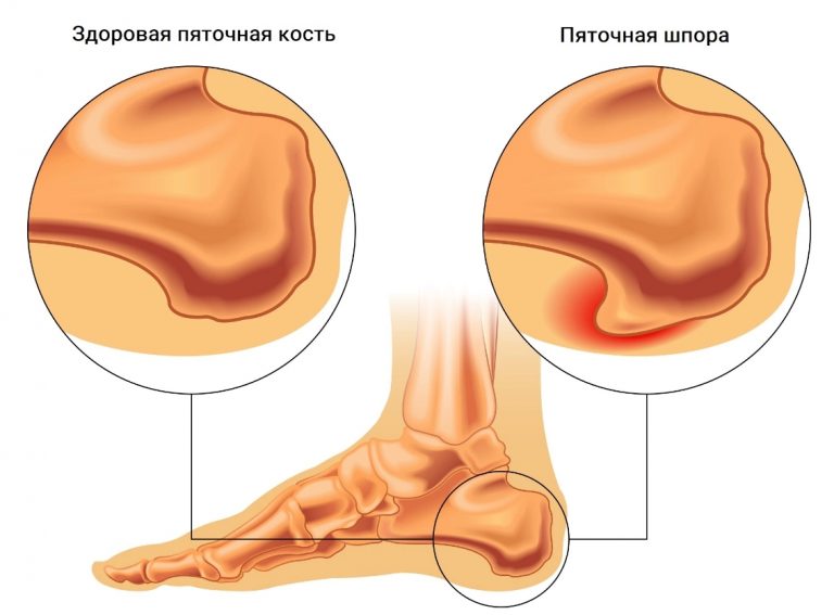 Пяточная шпора. Народные методы лечения пяточной шпоры