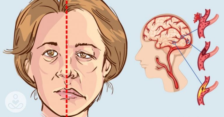 4 признака, что у человека сегодня может случиться инсульт