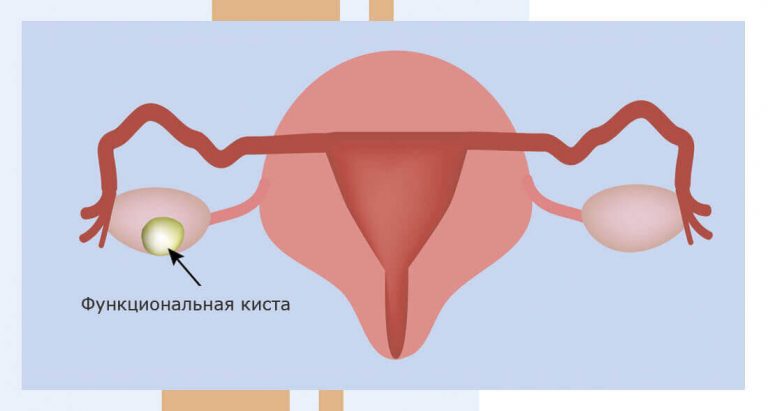Как избавиться от заболеваний яичников и матки всего за месяц. Рецепты наших бабушек