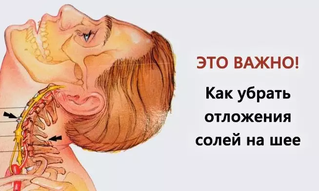 Убираем отложения солей на шее
