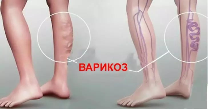 Врач-флеболог: «Запомните все! Варикоз не любит, когда ноги…»