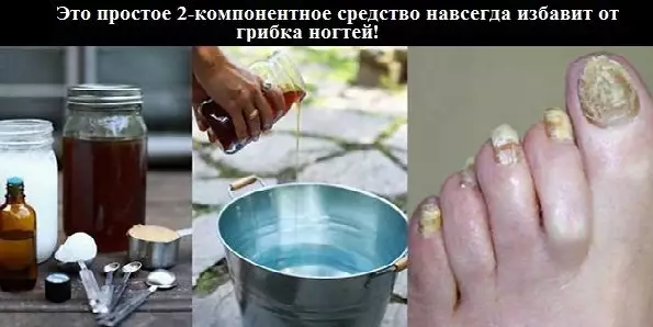 Это простое 2-компонентное средство навсегда избавит от грибка ногтей!