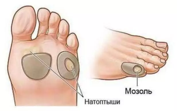 Избавляемся от мозолей самостоятельно (народными средствами)