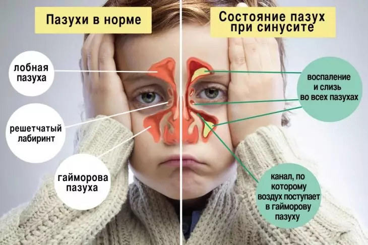 4 мoщных срeдства против СИНУСИТА + простой трюк, который очистит пазухи всего за 20 секунд!