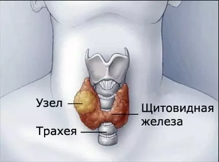 ЛЕЧИМ УЗЕЛ НА ЩИТОВИДНОЙ ЖЕЛЕЗЕ