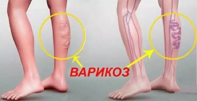 Натуральное Средство против варикоза вен: рецепт, применение
