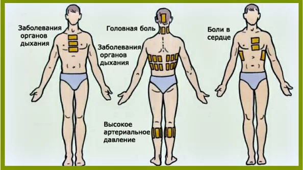 Как ПРАВИЛЬНО ставить горчичники