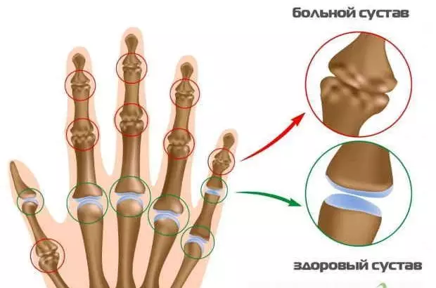 Лечение суставов по Болотову: без таблеток и уколов!