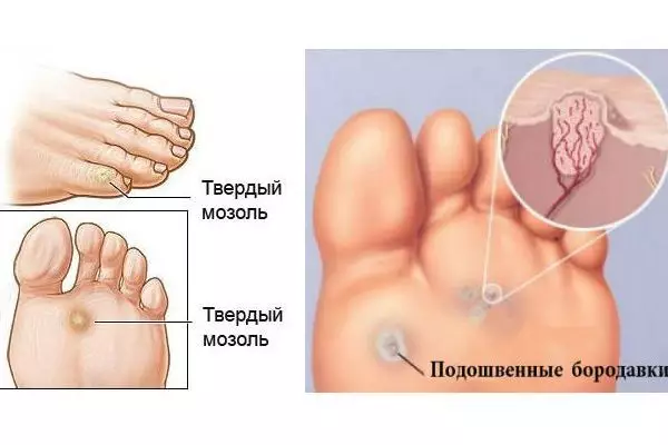 Мозоли и бородавки на ногах: как от них избавиться? Лучший способ, который действительно работает!