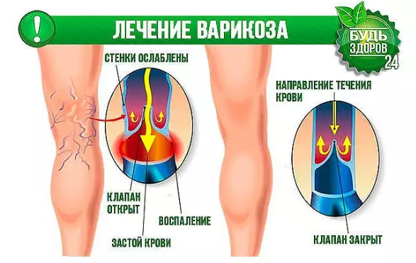 У вас проблемы с венами? Попробуйте эту мазь!