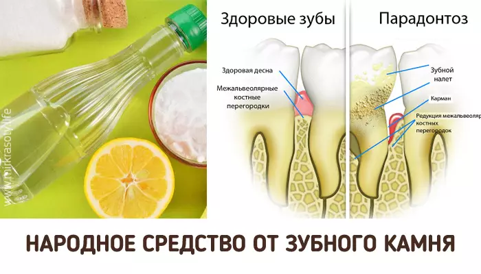 Как удалить зубной камень в домашних условиях? Эффект заметен с первого раза!