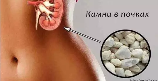 Поделюсь рецептом растворения камней в почках, который неоднократно проверен на родственниках и знакомых!